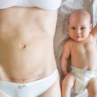 Closeup of woman belly with a scar from a cesarean section and her baby with raised hand near